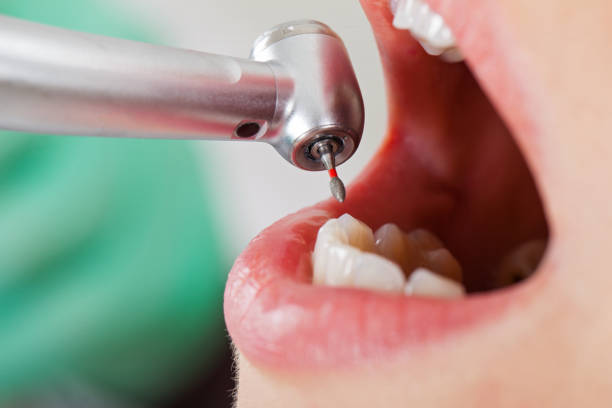 Best Emergency Tooth Extraction in Smithville, OH